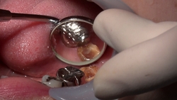 業餘葵的真實牙科治療影片（第三次：口腔特寫）*這是同名作品，僅包含口腔內部特寫！