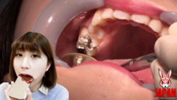 禦坂美琴（21）的真實牙科治療影片（第3次：口腔特寫）*這是僅包含口腔內部特寫的同名作品！