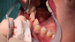 素人まことさんのリアル歯科治療映像 （６回目：口内接写映像）